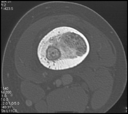 Chronic Osteomyelitis W/nidus - CTisus CT Scan