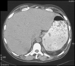 Sickle Cell Changes in Bone With Autosplenectomy - CTisus CT Scan