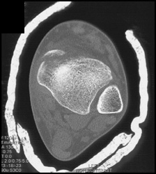 Tibial Fracture - CTisus CT Scan