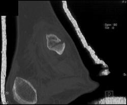 Tibial Fracture - CTisus CT Scan