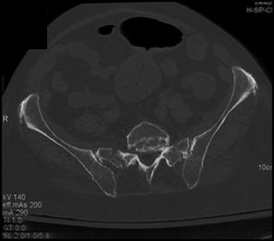 Stress Fracture of the Sacrum - CTisus CT Scan