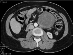 Ganglioneuroma - CTisus CT Scan