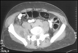 Psoas Abscess - CTisus CT Scan