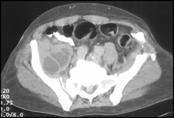 Psoas Abscess - CTisus CT Scan