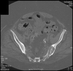 Infected Left SI Joint With Erosion Also in Right SI Joint - CTisus CT Scan