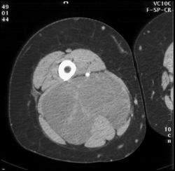 Liposarcoma - CTisus CT Scan