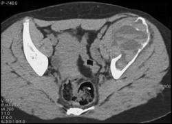 Aneurysmal Bone Cyst (ABC) W/fluid-fluid Levels - CTisus CT Scan