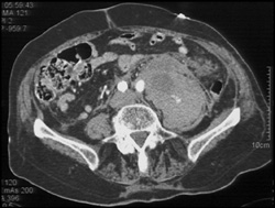 Active Psoas Bleed - CTisus CT Scan