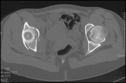 Acetabular Fracture - CTisus CT Scan