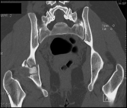 Acetabular Fracture - CTisus CT Scan