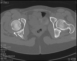 Acetabular Fracture - CTisus CT Scan