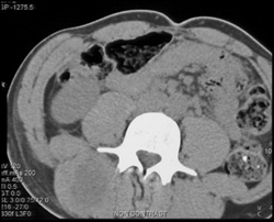 Intramuscular Abscess Seen Best With IV Contrast - CTisus CT Scan