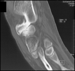 Fibrous Coalition - CTisus CT Scan