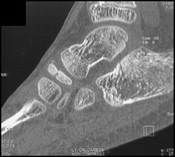 Calcaneal Fracture - CTisus CT Scan