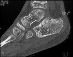 Calcaneal Fracture - CTisus CT Scan