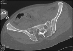 Sacral Fracture - CTisus CT Scan