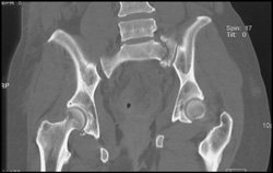 Sacral Fracture - CTisus CT Scan