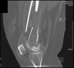 Femur Fracture - CTisus CT Scan