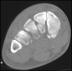 Tarsal Fracture - CTisus CT Scan