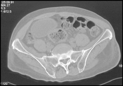 Infected Right SI Joint - CTisus CT Scan