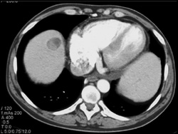 Extramedullary Hematopoiesis in the Liver - CTisus CT Scan