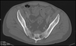 Extramedullary Hematopoiesis in the Sacrum - CTisus CT Scan