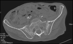 Sacral Fracture - CTisus CT Scan