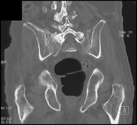 Sacral Fracture - CTisus CT Scan