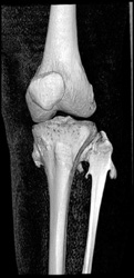 Multiple Hereditary Exostoses - CTisus CT Scan