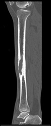 Benign Bone Cyst - CTisus CT Scan