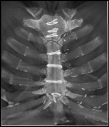 Healing Medial Sternotomy - CTisus CT Scan