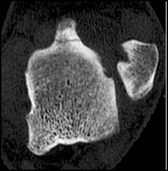 Talus Fracture - CTisus CT Scan