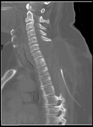 Post Operative Hematoma - CTisus CT Scan