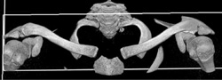 Normal S-c Joints - CTisus CT Scan