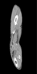 Trauma With Fat/fluid Level - CTisus CT Scan