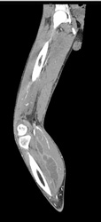 Fluid Tracks Into Gastrocnemius Muscle - CTisus CT Scan