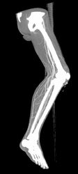 CTA of Calf - CTisus CT Scan