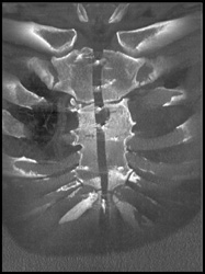 Nonunion of Sternum With Broken Wires - CTisus CT Scan