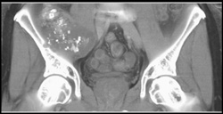 Chondrosarcoma Iliac Bone - CTisus CT Scan