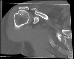 Prior Repair of Shoulder Injury - CTisus CT Scan