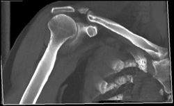 Prior Clavicle Fracture With Bone Fragment and A-c Joint Space - CTisus CT Scan