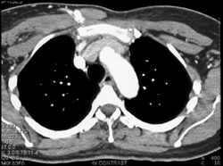 Arteriovenous (AV) Fistulae in Chest Wall Following Stab Wound - CTisus CT Scan