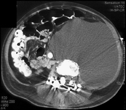 Lymphocele S/P Spine Surgery - CTisus CT Scan