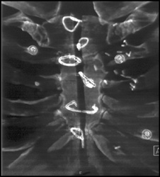 Nonunion Sternum With Broken Wires - CTisus CT Scan