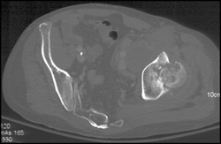 Osteomyelitis With Septic Joint - CTisus CT Scan