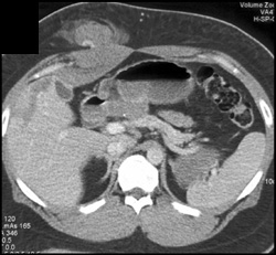 Abdominal Wall Bleed S/P Stab Wound - CTisus CT Scan