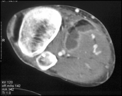 Trauma to Calf With Fat/fluid Level - CTisus CT Scan