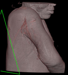 Abscess Without Vascular Involvement - CTisus CT Scan