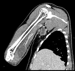 Abscess With Axillary Nodes Was Cat Scratch Fever - CTisus CT Scan