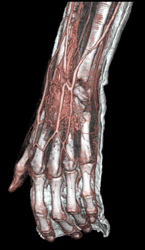 Cellulitis - CTisus CT Scan